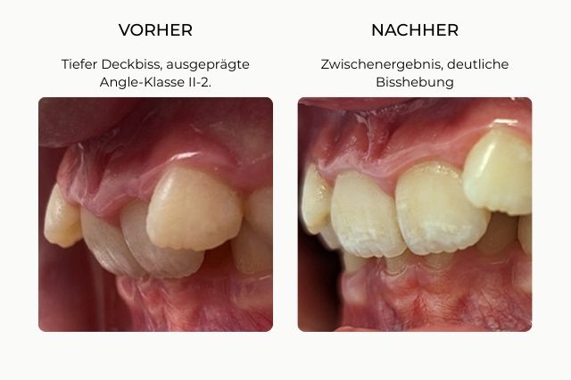 krankenkasse versicherung Vorher und Nachher vergleich Dentosophie Behandlung