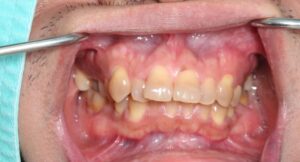 extreme zahnfehlstellung