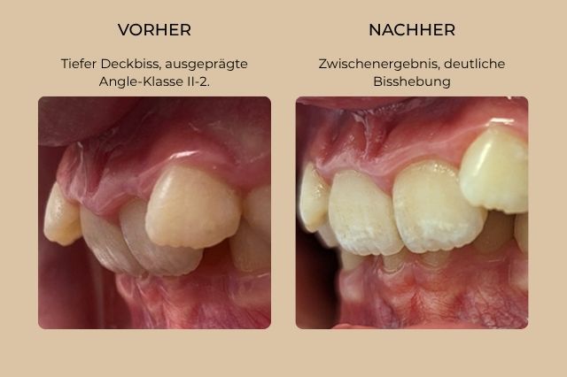 extreme zahnfehlstellung dentosophie extreme zahnfehlstellung dentosophie