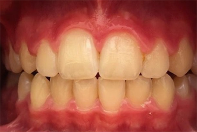 Dentosophie 7 Jahreskontrolle Nachher