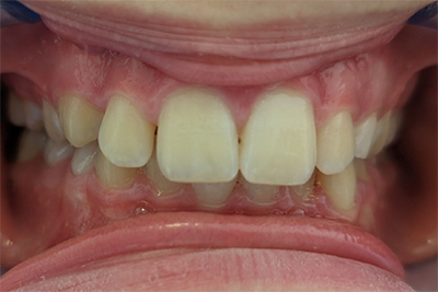 Dentosophie 7 Jahreskontrolle Vorher